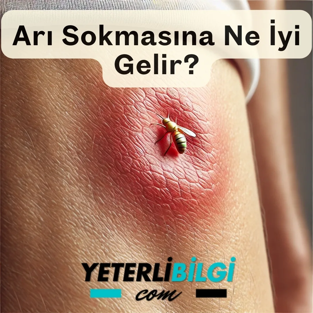 Arı Sokmasına Ne İyi Gelir