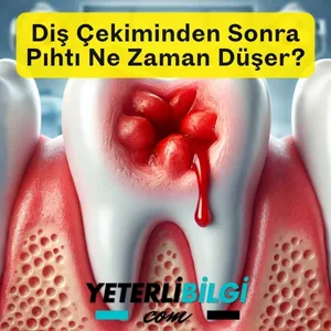 Diş Çekiminden Sonra Pıhtı Ne Zaman Düşer