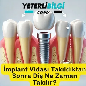 İmplant Vidası Takıldıktan Sonra Diş Ne Zaman Takılır